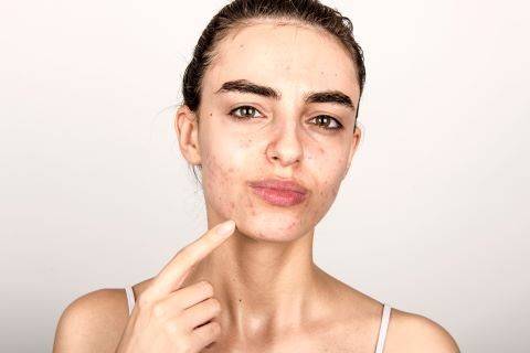 What Treatments Can You Get from the Pharmacy for Acne?