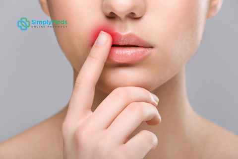 What Causes Cold Sores and What Treatment is Available for Self Care?