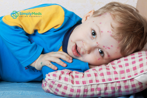Chickenpox - How Can You Ease the Itch for Your Little Ones?