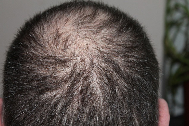 Can Hair Loss Be Linked To An Excess Of Male Hormones? | Hair Loss  Treatment UK
